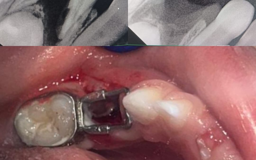 Tooth Space Maintainer for Children